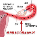 輸卵管性不孕