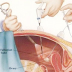 輸卵管性不孕