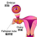 輸卵管性不孕